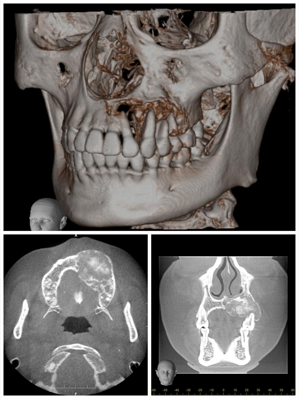 上颌骨及其相关联骨骨折-临床应用解剖学-医学